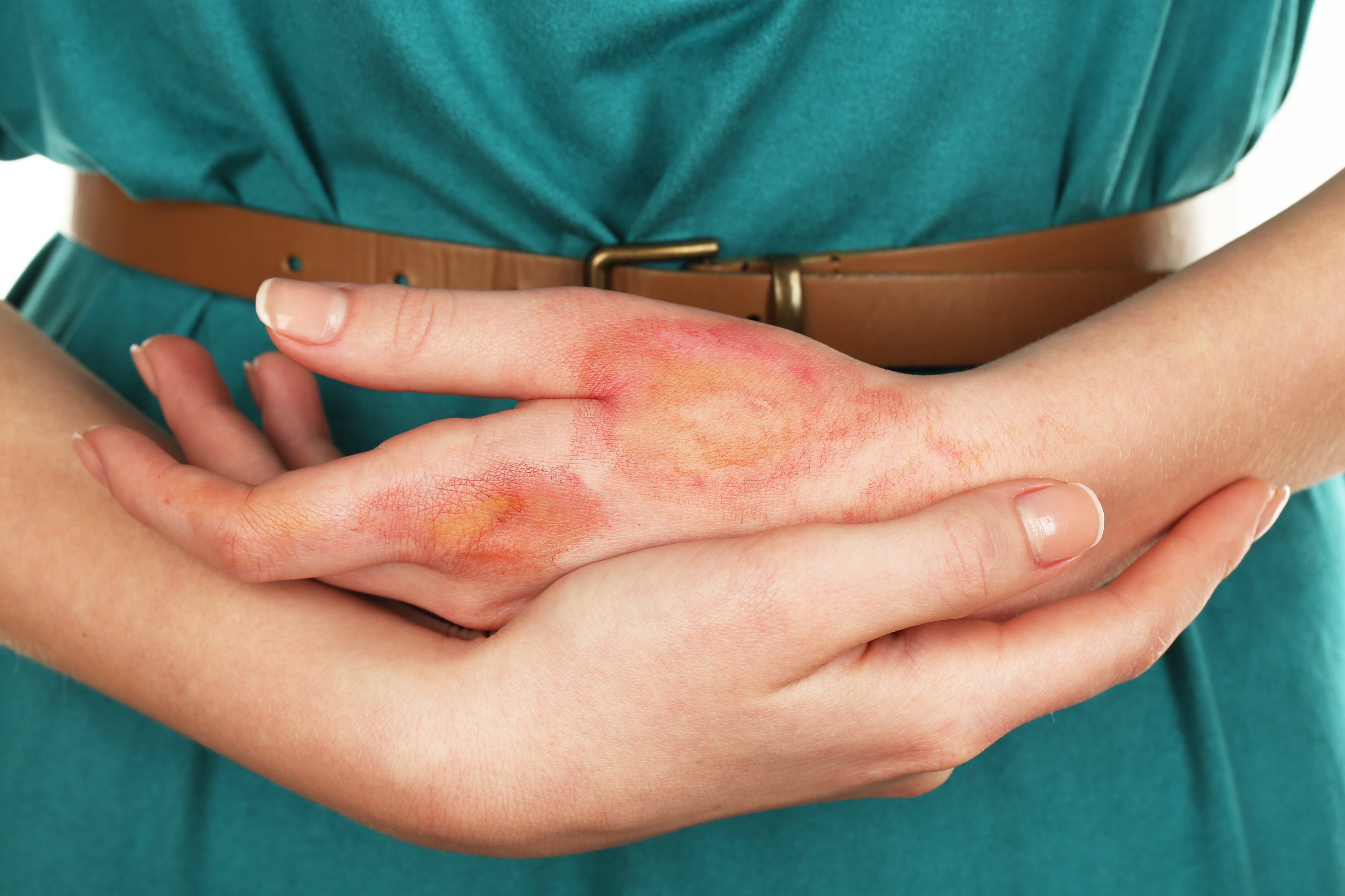 rash on woman's hand